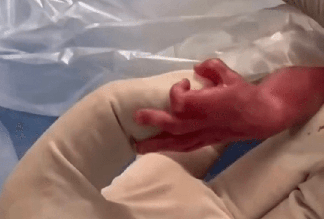 Bebê de 600 gramas"segura" dedo de enfermeira ao nascer