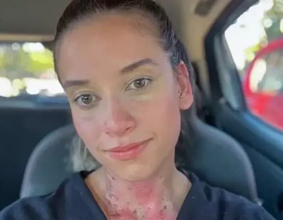 Empresária sofre queimaduras ao abrir capô de carro