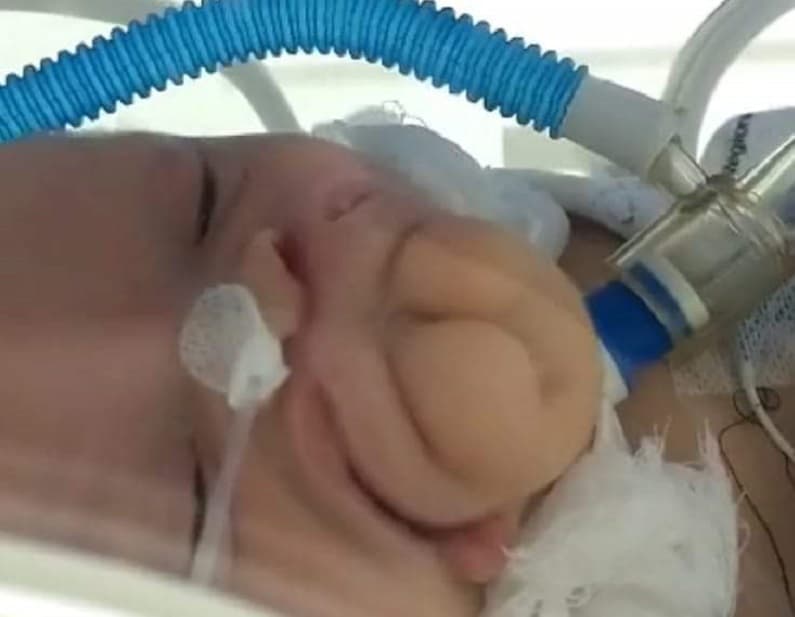 A bebê não consegue respirar sem a ajuda de aparelhos  (Foto: Divulgação )