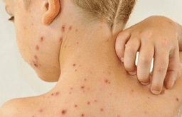 Brasil tem 37 casos de sarampo, mas ainda é área livre da doença (Foto: Reprodução/Internet)