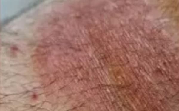 Micose em paciente com registro de viagens internacionais (Foto: Divulgação)