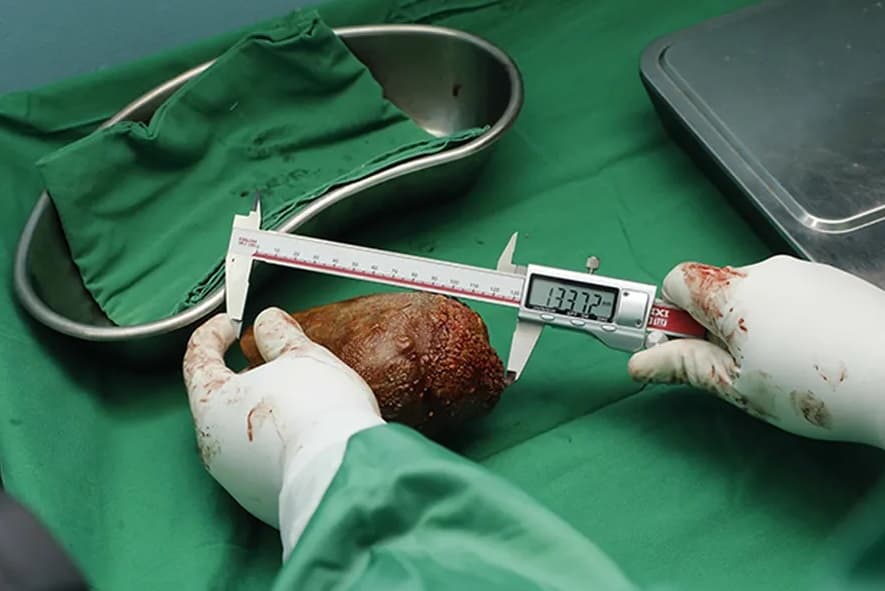 Cálculo renal entrou para o Guinness Book (Foto: Exército do Sri Lanka)