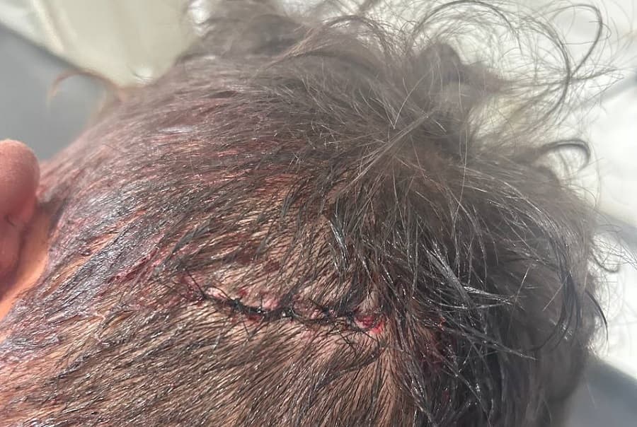 Vítima precisou de pontos na cabeça (Foto: Polícia Militar)