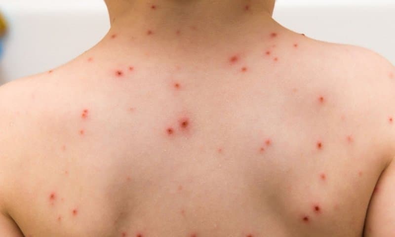 Casos de varicela foram registrados nas últimas semanas em Pinhalzinho  (Foto: Divulgação )