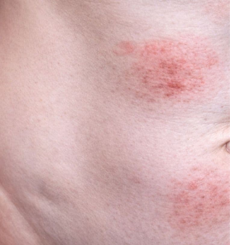 Infecção que vem preocupando é causada por fungo microscópico (Foto por Centros de Controle e Prevenção de Doenças)