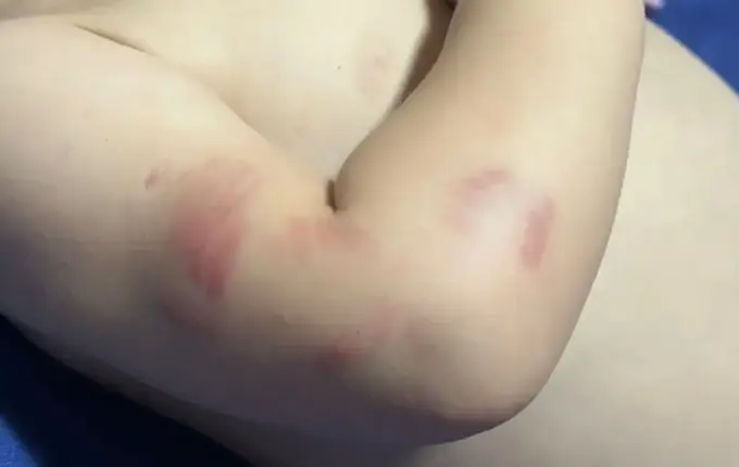 Crianças com marcas pelo corpo (Foto por Arquivo pessoal)