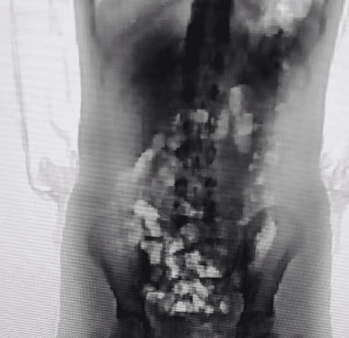 Menina tentar entrar com "supermaconha" escondida no corpo em presídio
