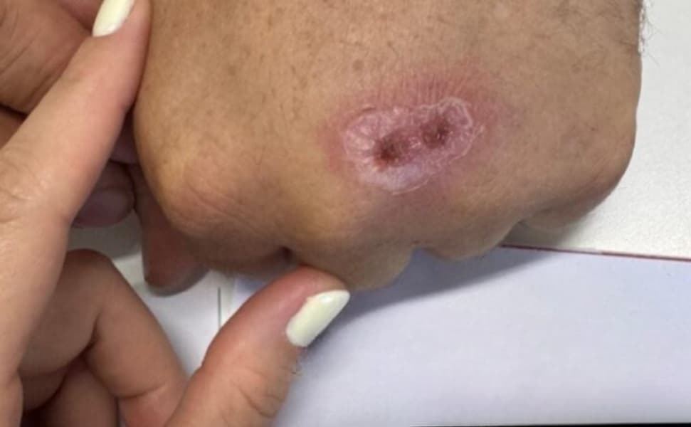 Esporotricose foi identificada em um homem de 40 anos (Foto por Divulgação)