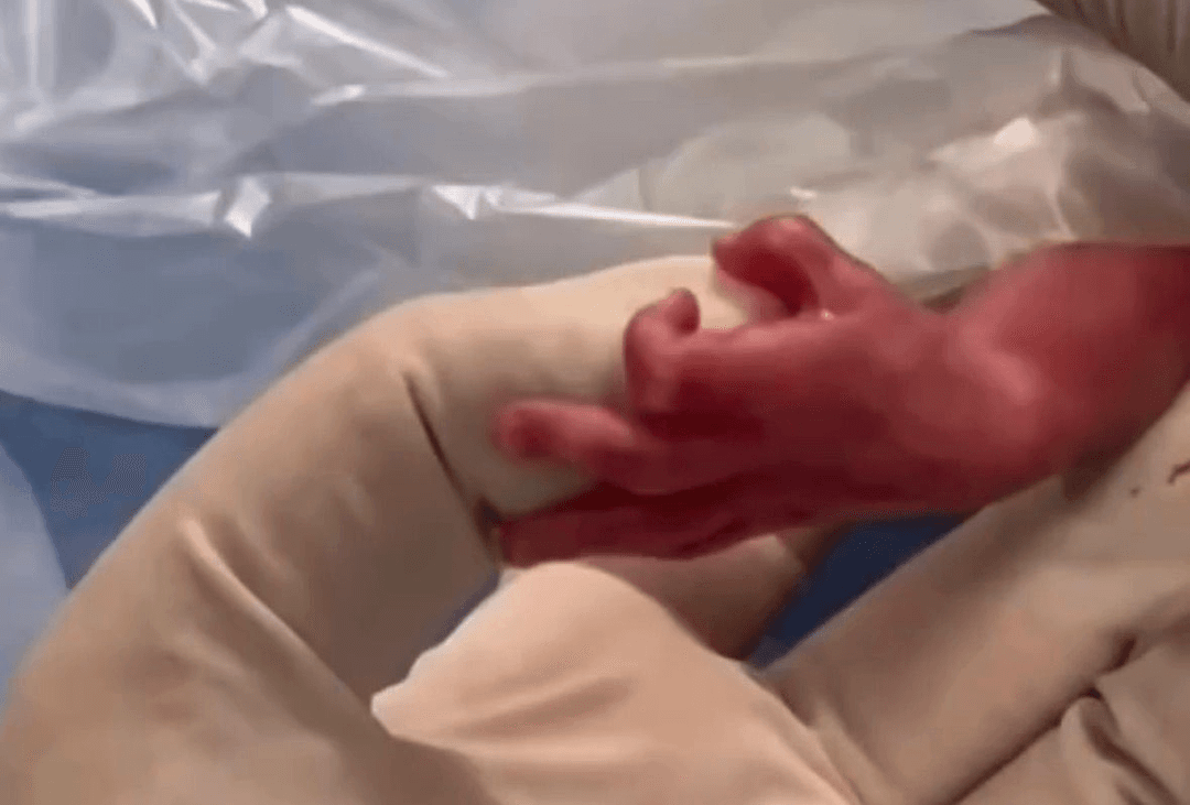 Bebê de 600 gramas"segura" dedo de enfermeira ao nascer