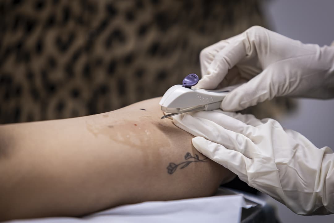 NOVA ERECHIM: Unidade de Saúde passa a disponibilizar Implanon para ampliar acesso ao planejamento familiar