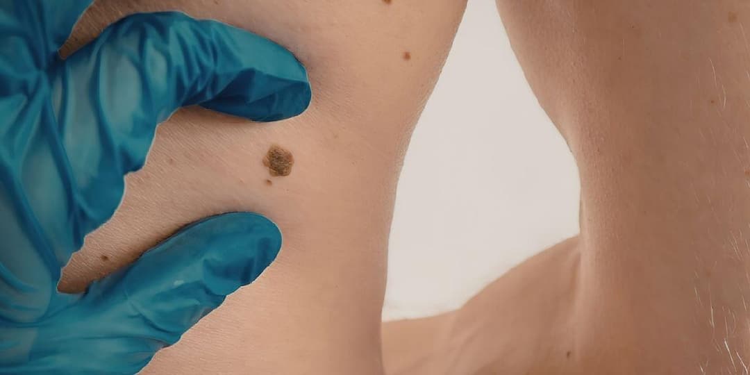 Junho Preto alerta para avanço do melanoma em Santa Catarina