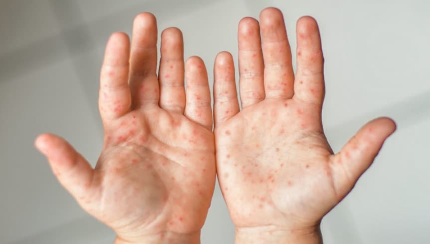 Casos de Mão-Pé-Boca aumentam nas escolas de Pinhalzinho (Foto: Clinica Coutinho )
