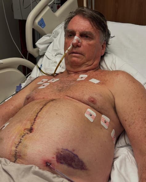 Ex-presidente ficou internado na UTI após nova cirurgia (Foto: Reprodução/Redes Sociais)