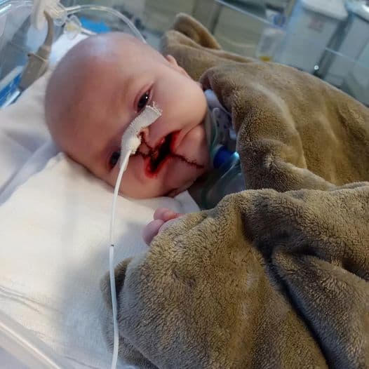 A pequena Helena está acordada, sem sedativos, apenas com remédios para dor (Foto: Divulgação)