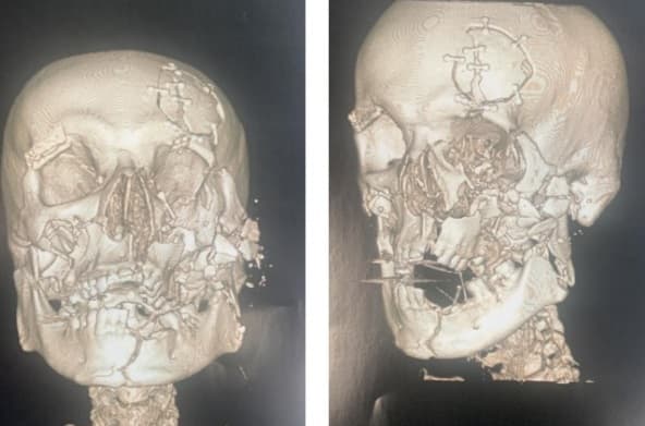 Raio-x mostra gravidade das lesões (Foto: Polícia Civil)
