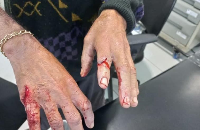 Mãos da vítima após o ocorrido (Foto: Polícia Militar)